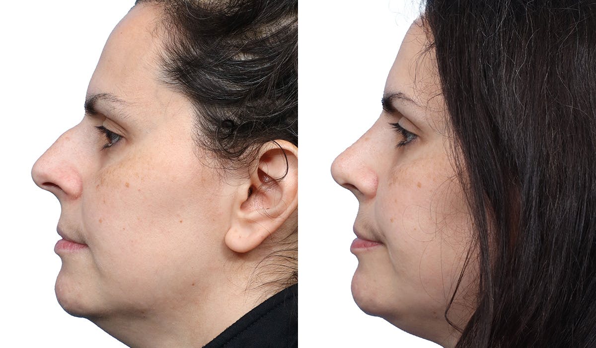Rhinoplasty Before & After Gallery - Patient 316075 - Image 2
