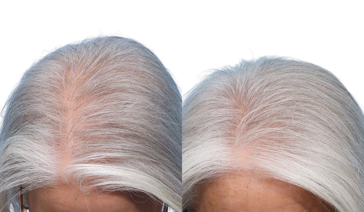 Platelet-Rich-Plasma Before & After Gallery - Patient 174059 - Image 3