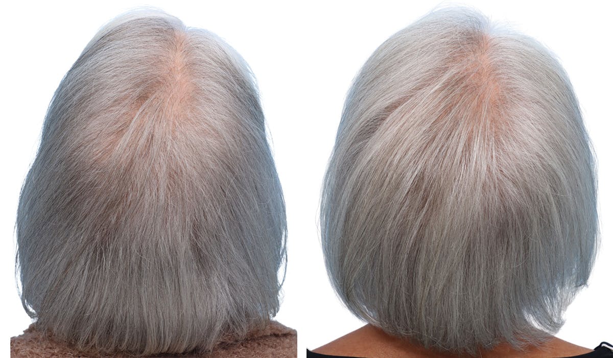 Platelet-Rich-Plasma Before & After Gallery - Patient 174059 - Image 1
