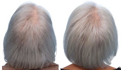 Platelet-Rich-Plasma Before & After Gallery - Patient 174059 - Image 1