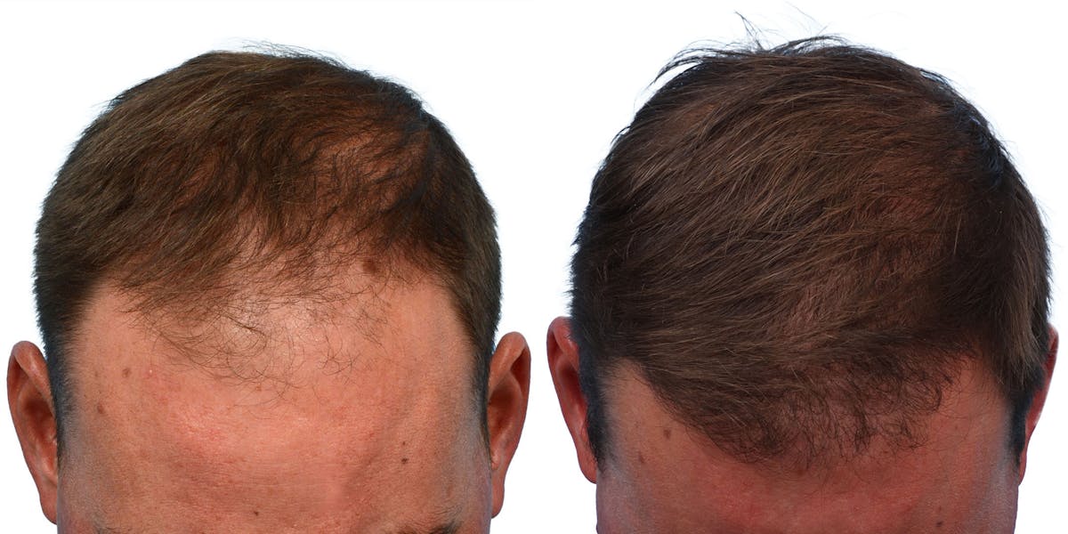 FUE Hair Transplant Before & After Gallery - Patient 165007 - Image 1
