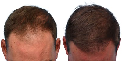 FUE Hair Transplant Before & After Gallery - Patient 165007 - Image 1