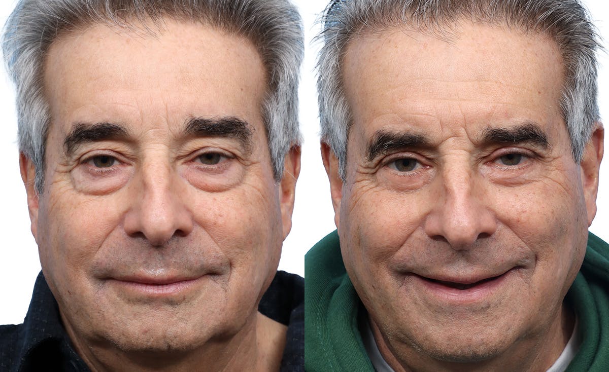 Blepharoplasty (Eyelid Surgery) Before & After Gallery - Patient 321856 - Image 1
