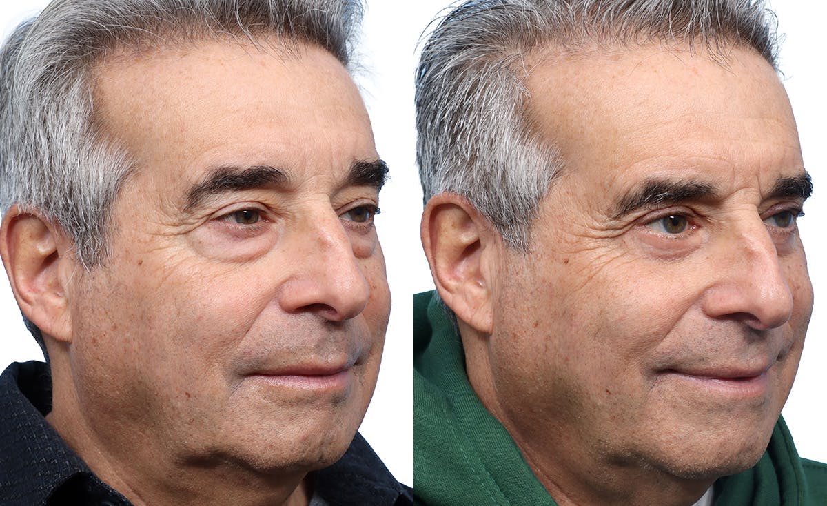 Blepharoplasty (Eyelid Surgery) Before & After Gallery - Patient 321856 - Image 2