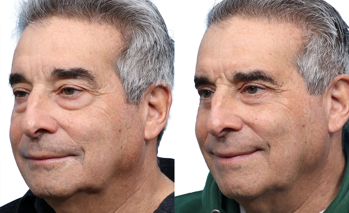 Blepharoplasty (Eyelid Surgery) Before & After Gallery - Patient 321856 - Image 3