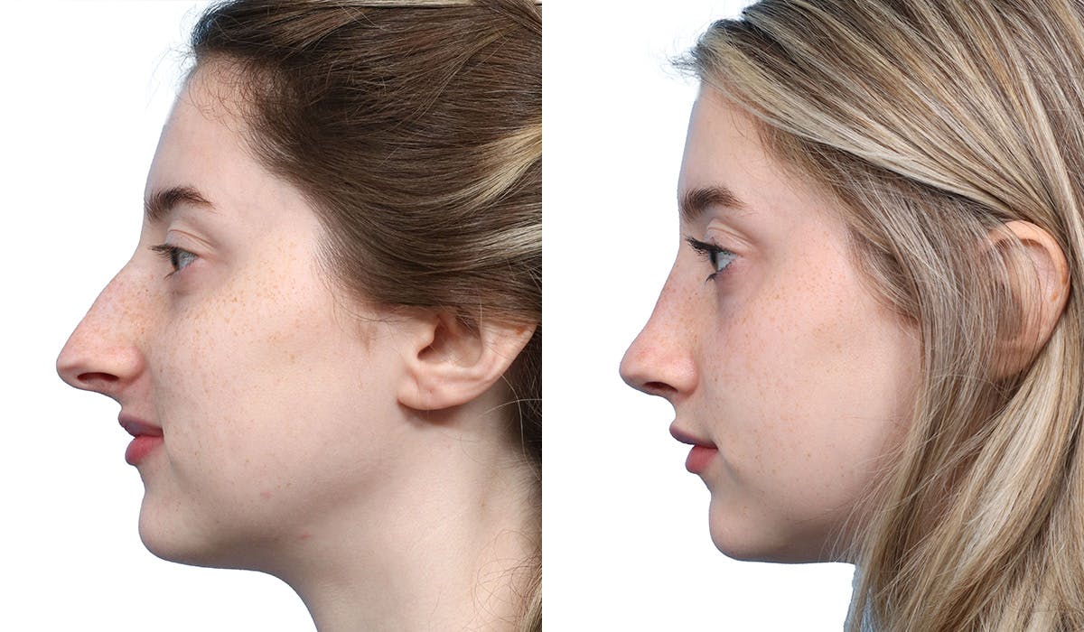 Rhinoplasty Before & After Gallery - Patient 400067 - Image 2