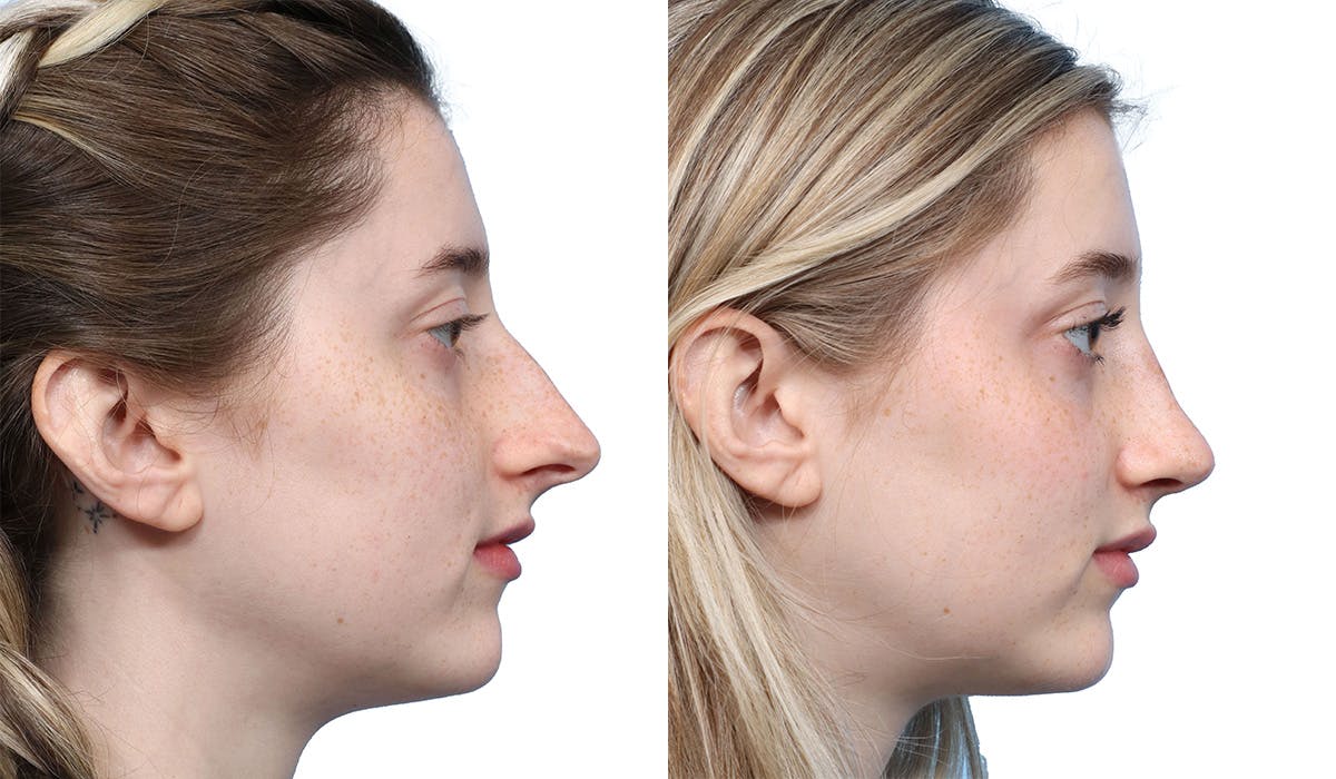 Rhinoplasty Before & After Gallery - Patient 400067 - Image 1