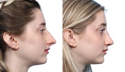 Rhinoplasty Before & After Gallery - Patient 400067 - Image 1