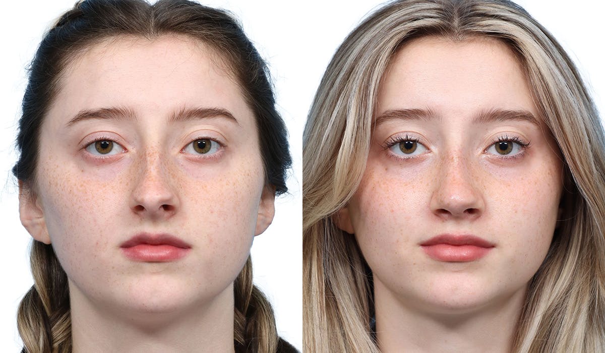 Rhinoplasty Before & After Gallery - Patient 400067 - Image 3