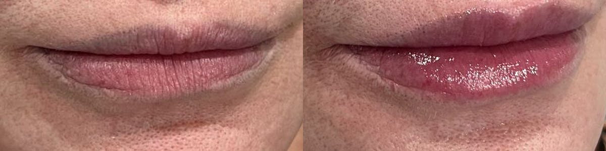 Lip Enhancement Before & After Gallery - Patient 323510 - Image 1