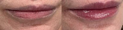 Lip Enhancement Before & After Gallery - Patient 323510 - Image 1