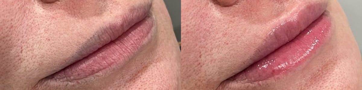 Lip Enhancement Before & After Gallery - Patient 323510 - Image 2