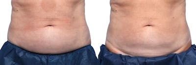 CoolSculpting® Before & After Gallery - Patient 284094 - Image 1