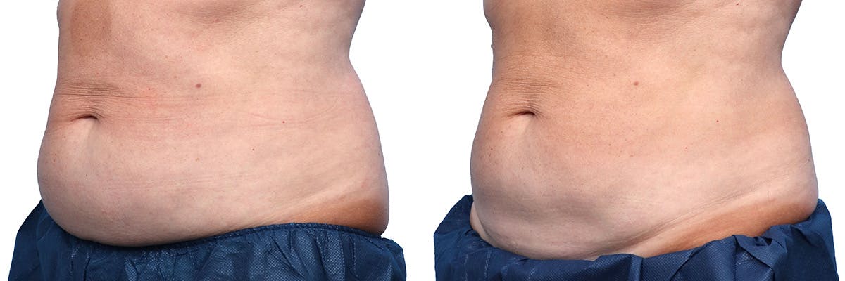 CoolSculpting® Before & After Gallery - Patient 284094 - Image 2
