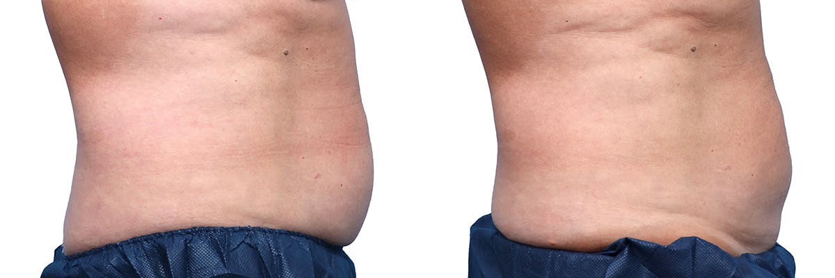 CoolSculpting® Before & After Gallery - Patient 284094 - Image 4