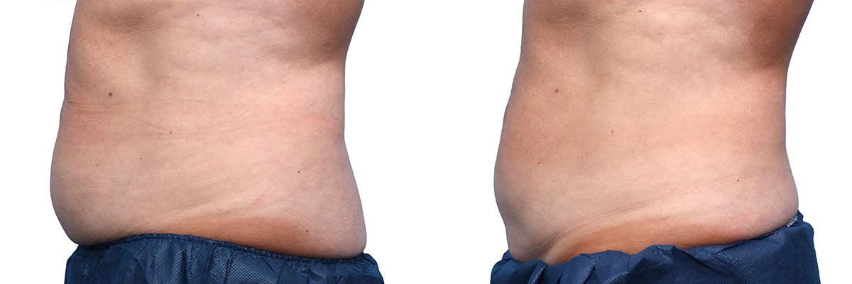 CoolSculpting® Before & After Gallery - Patient 284094 - Image 3