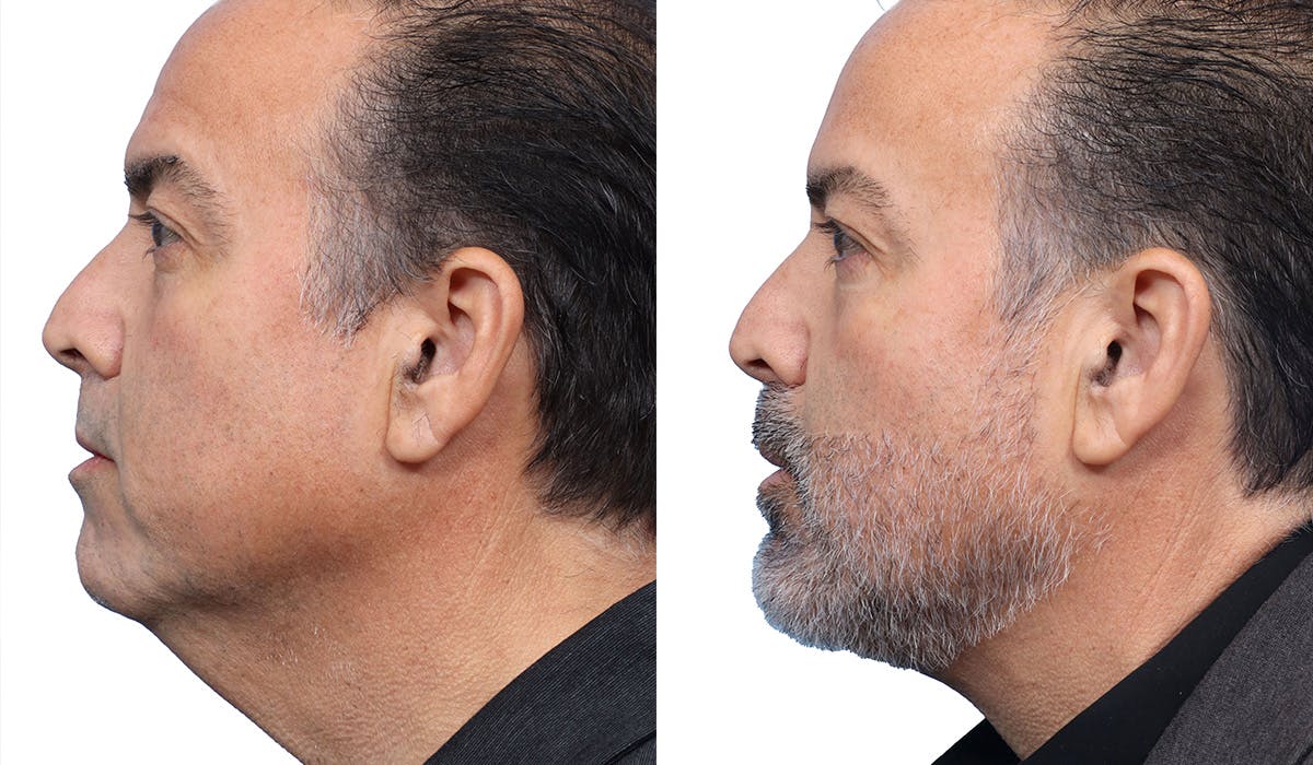 Chin Augmentation Before & After Gallery - Patient 273515 - Image 3