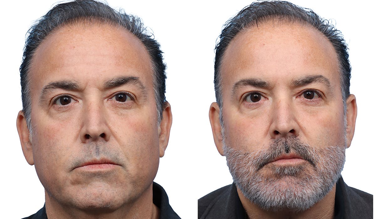 Chin Augmentation Before & After Gallery - Patient 273515 - Image 2