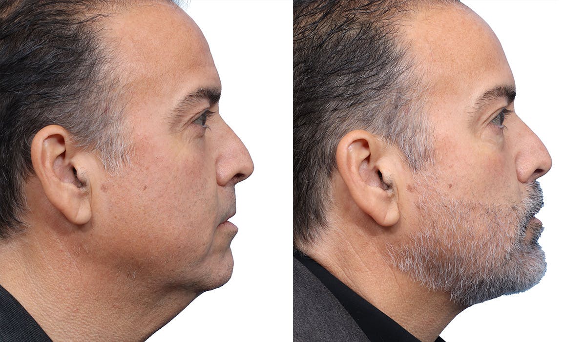 Chin Augmentation Before & After Gallery - Patient 273515 - Image 1