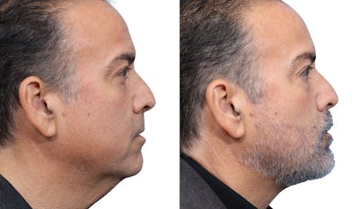 Chin Augmentation Before & After Gallery - Patient 273515 - Image 1