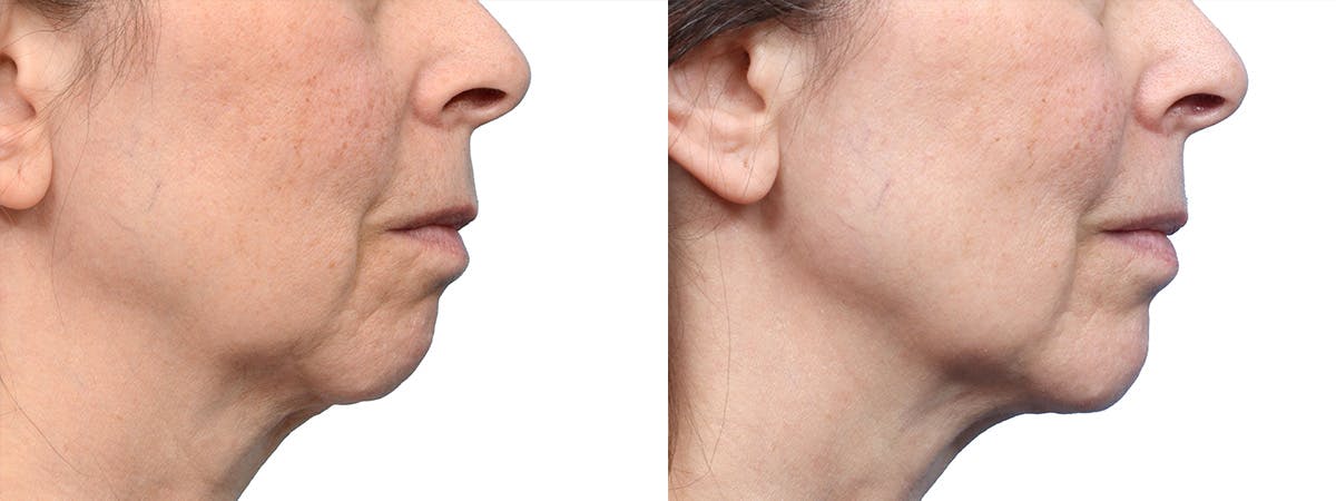 Chin Augmentation Before & After Gallery - Patient 992585 - Image 1