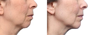 Chin Augmentation Before & After Gallery - Patient 992585 - Image 1