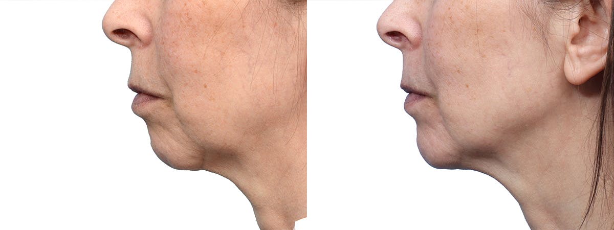 Chin Augmentation Before & After Gallery - Patient 992585 - Image 2