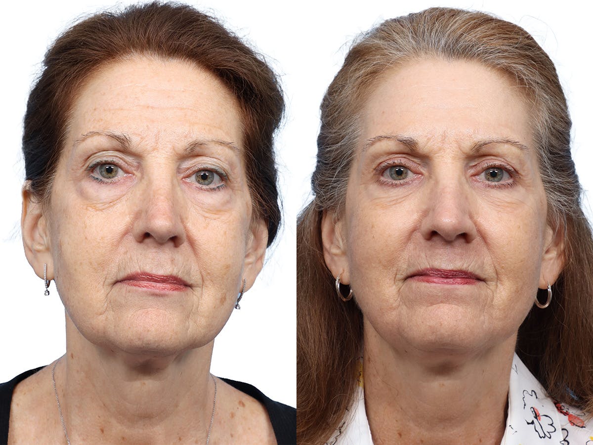 Blepharoplasty (Eyelid Surgery) Before & After Gallery - Patient 255313 - Image 1