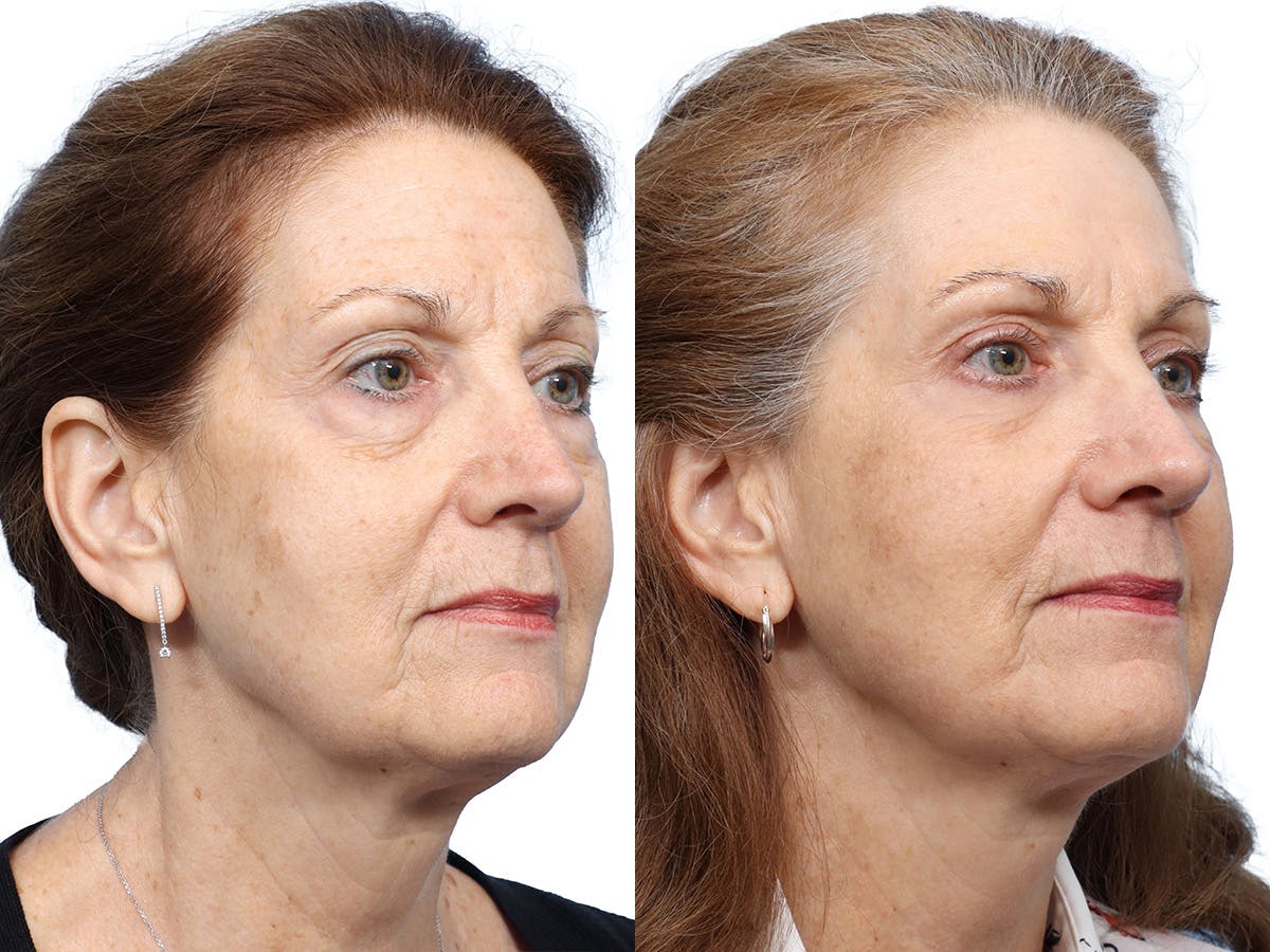 Blepharoplasty (Eyelid Surgery) Before & After Gallery - Patient 255313 - Image 2
