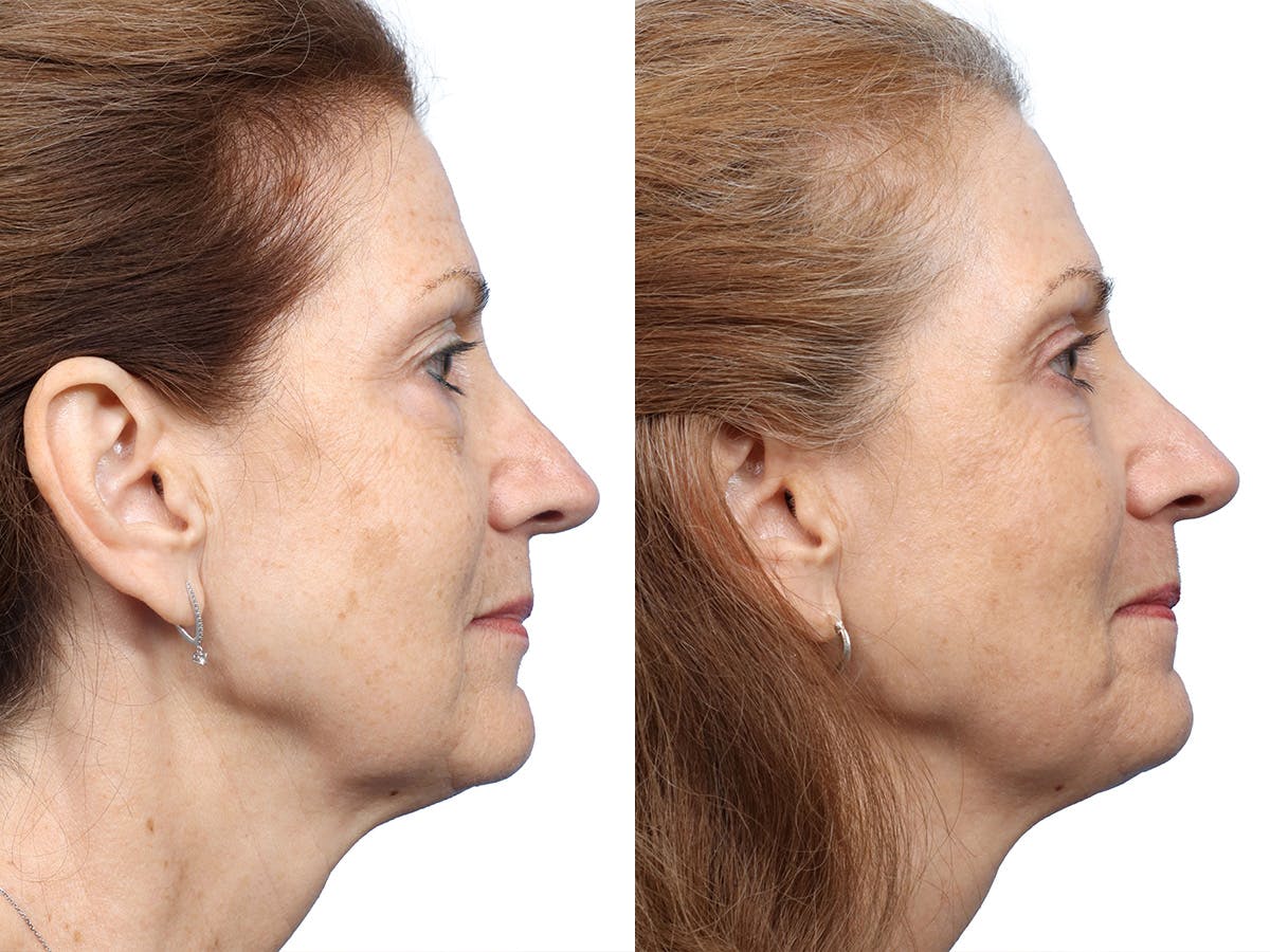 Blepharoplasty (Eyelid Surgery) Before & After Gallery - Patient 255313 - Image 3