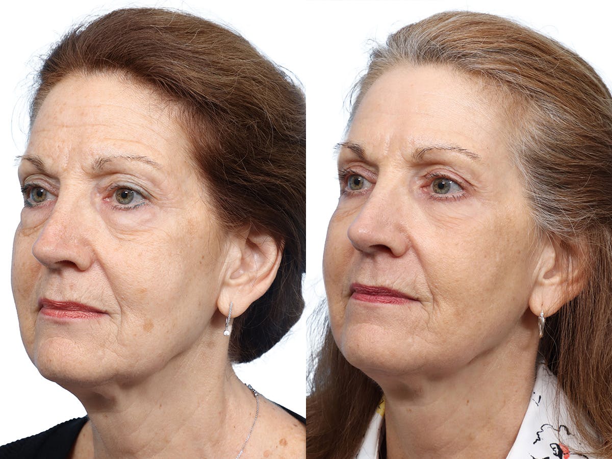 Blepharoplasty (Eyelid Surgery) Before & After Gallery - Patient 255313 - Image 4