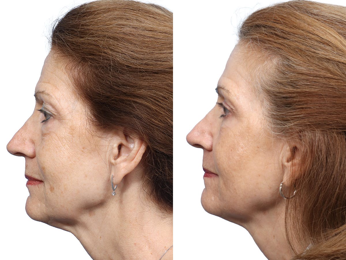 Blepharoplasty (Eyelid Surgery) Before & After Gallery - Patient 255313 - Image 5