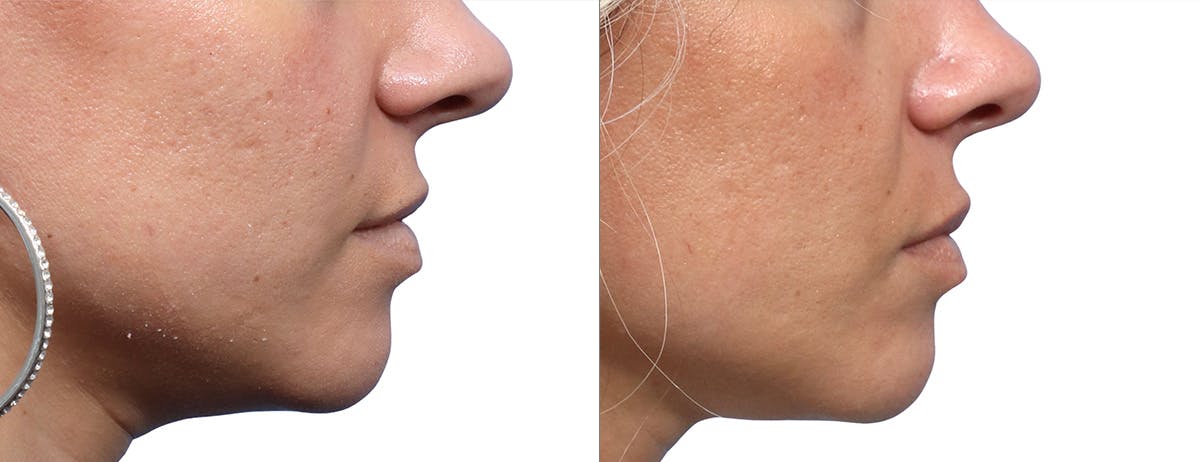 Skinpen Microneedling Before & After Gallery - Patient 319577 - Image 2