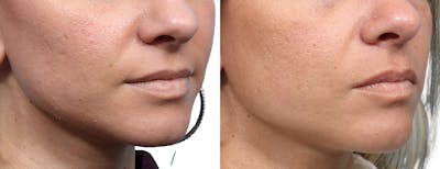 Skinpen Microneedling Before & After Gallery - Patient 319577 - Image 1