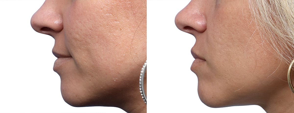 Skinpen Microneedling Before & After Gallery - Patient 319577 - Image 4