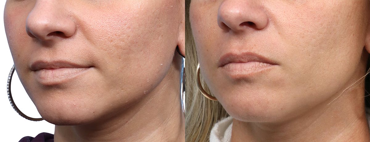 Skinpen Microneedling Before & After Gallery - Patient 319577 - Image 3