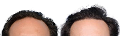 FUE Hair Transplant Before & After Gallery - Patient 208709 - Image 1