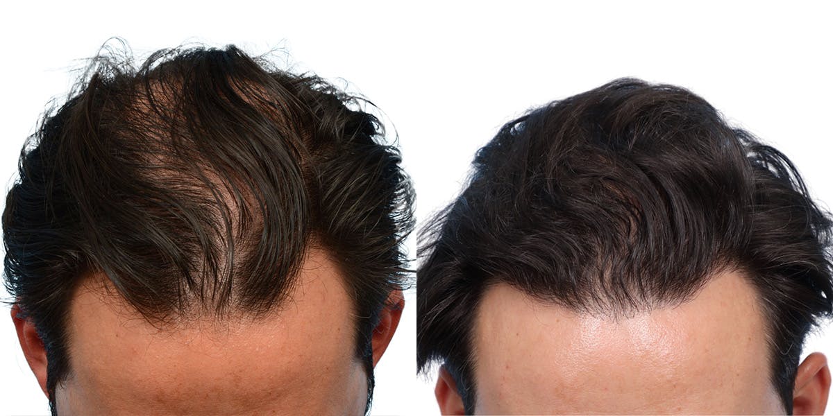 FUE Hair Transplant Before & After Gallery - Patient 208709 - Image 2