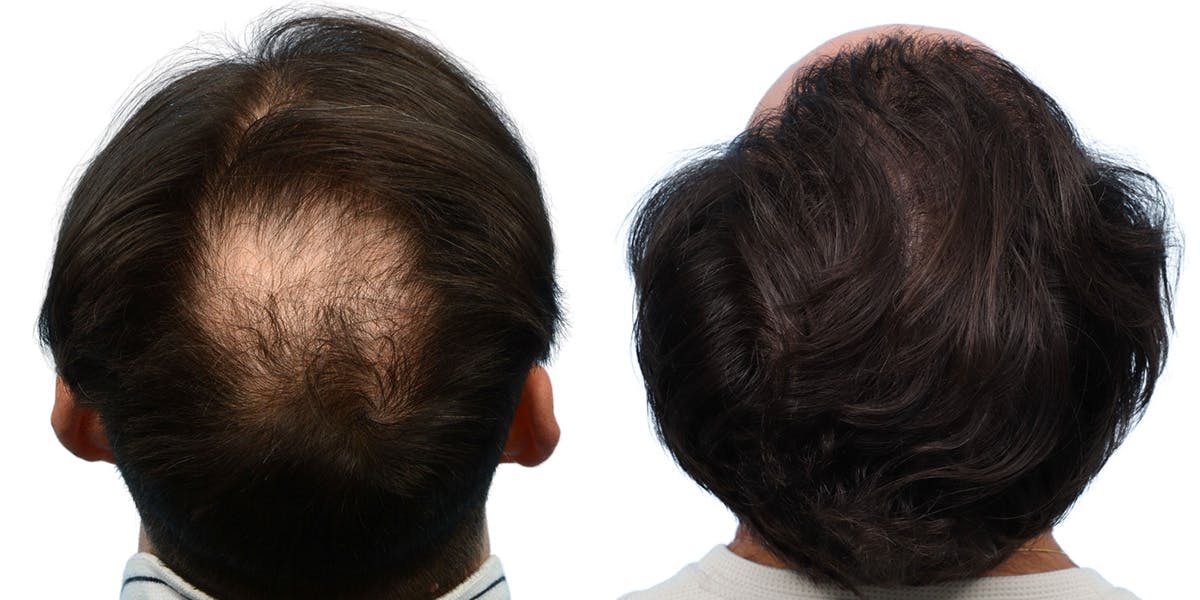 FUE Hair Transplant Before & After Gallery - Patient 208709 - Image 3