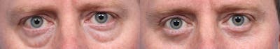 Blepharoplasty (Eyelid Surgery) Before & After Gallery - Patient 706408 - Image 1
