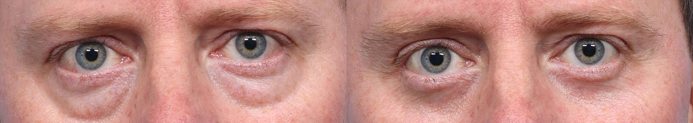 Blepharoplasty (Eyelid Surgery) Before & After Gallery - Patient 706408 - Image 1
