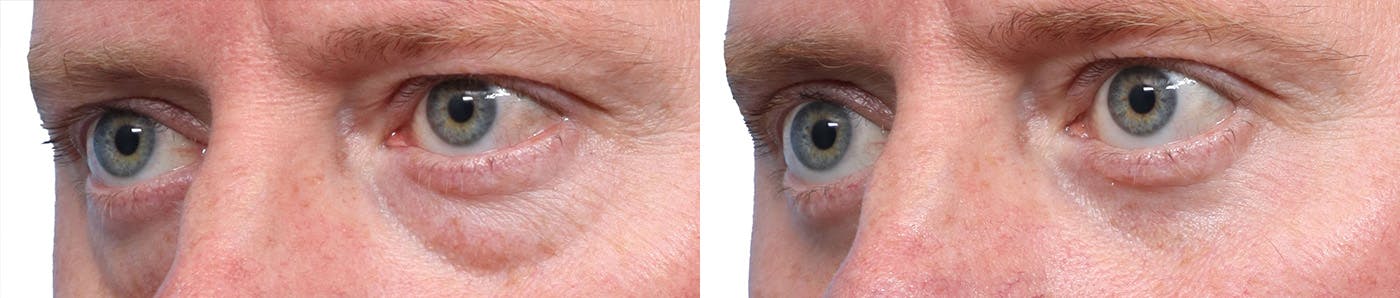 Blepharoplasty (Eyelid Surgery) Before & After Gallery - Patient 706408 - Image 3