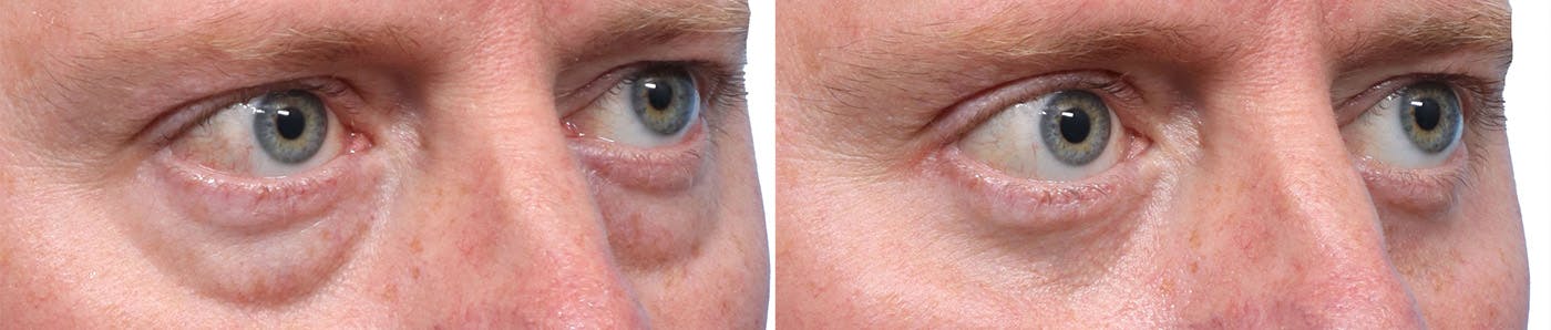 Blepharoplasty (Eyelid Surgery) Before & After Gallery - Patient 706408 - Image 2