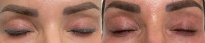 Tattoo Removal Before & After Gallery - Patient 276127 - Image 1