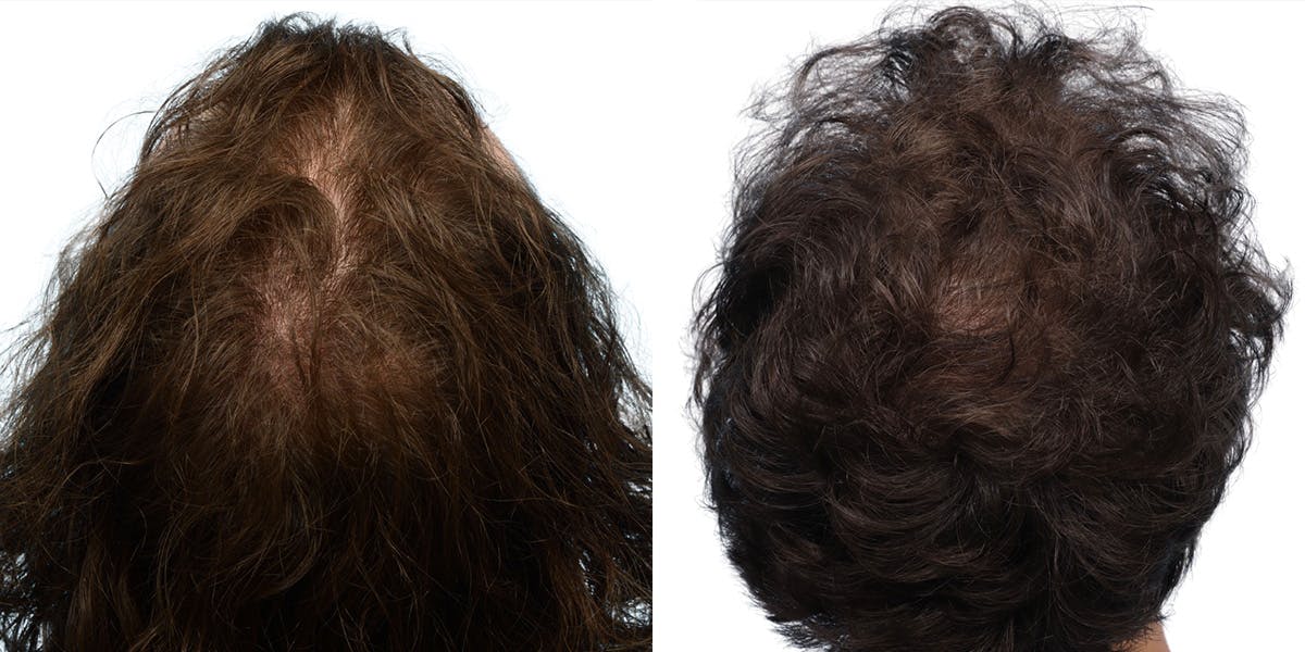 FUE Hair Transplant Before & After Gallery - Patient 284254 - Image 1