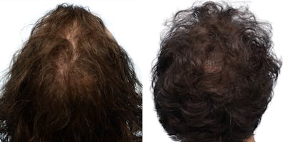 FUE Hair Transplant Before & After Gallery - Patient 284254 - Image 1