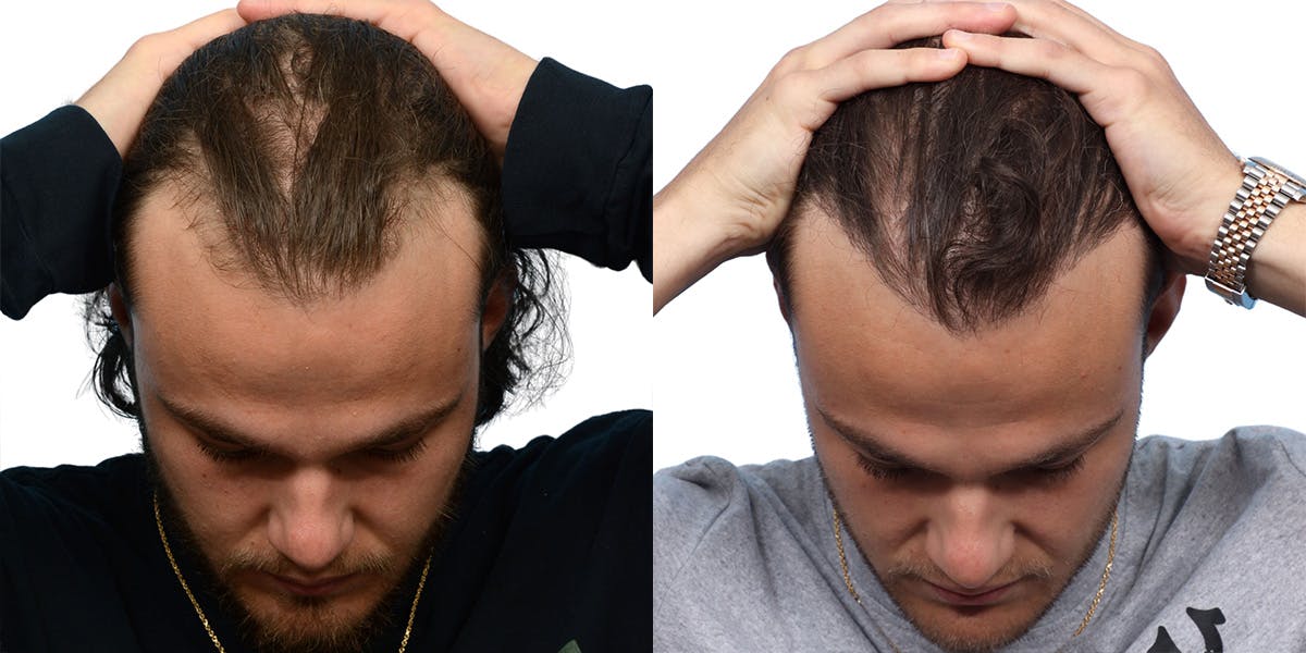 FUE Hair Transplant Before & After Gallery - Patient 284254 - Image 2