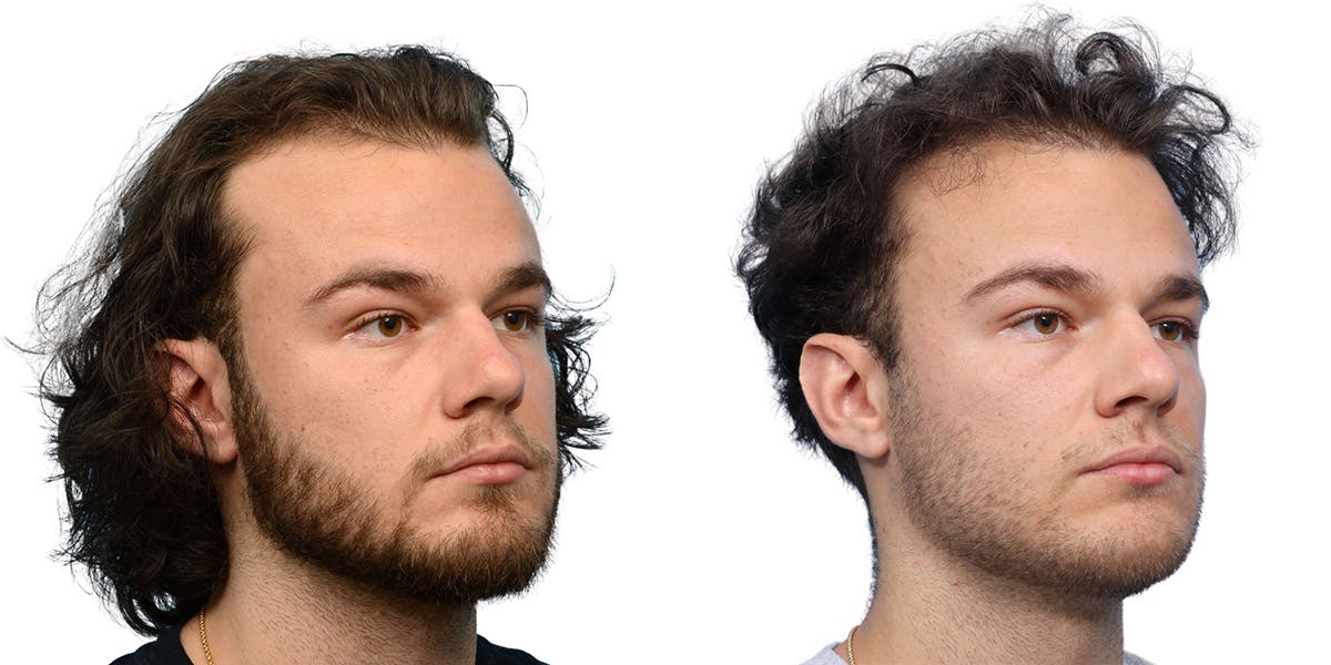 FUE Hair Transplant Before & After Gallery - Patient 284254 - Image 3