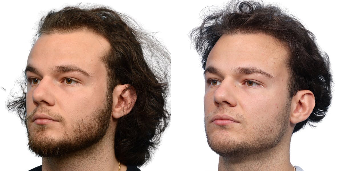 FUE Hair Transplant Before & After Gallery - Patient 284254 - Image 4