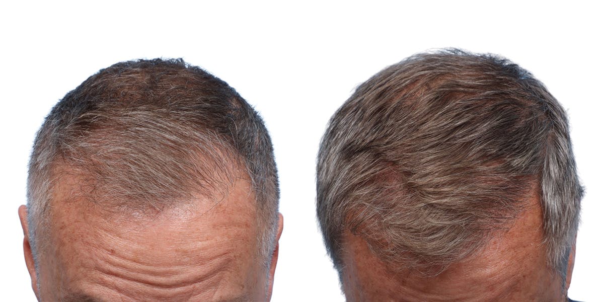 FUE Hair Transplant Before & After Gallery - Patient 200067 - Image 2